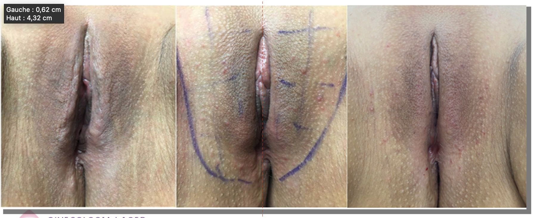 vulvar-tension-endopeel