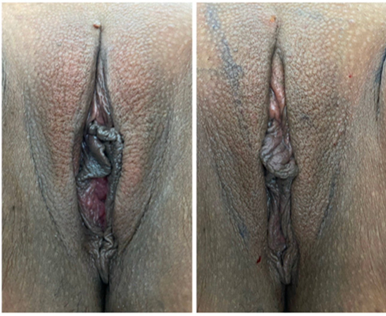 reposicionamineto-muscular4-endopeel