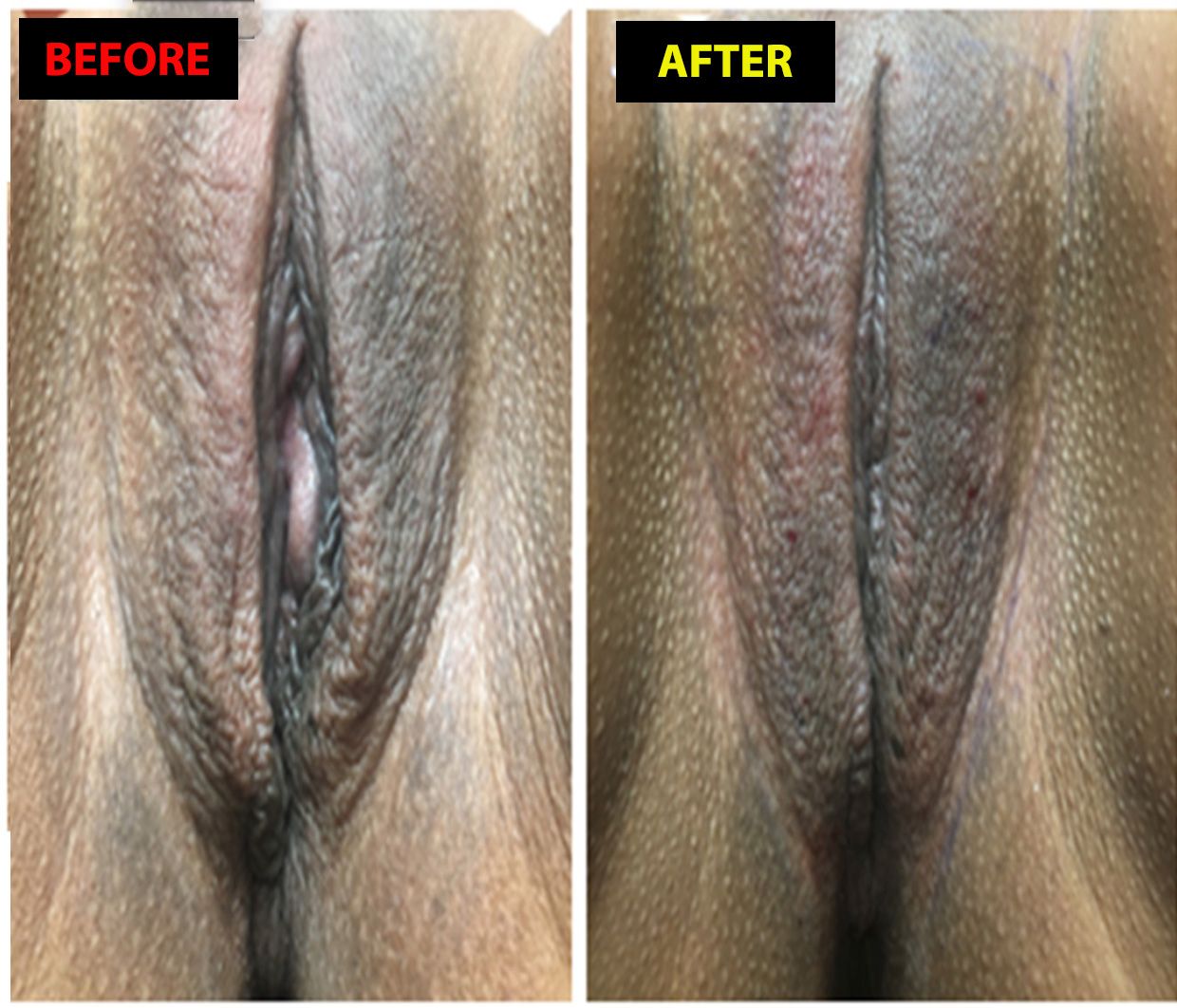 myotension-hypotonic-sc-3