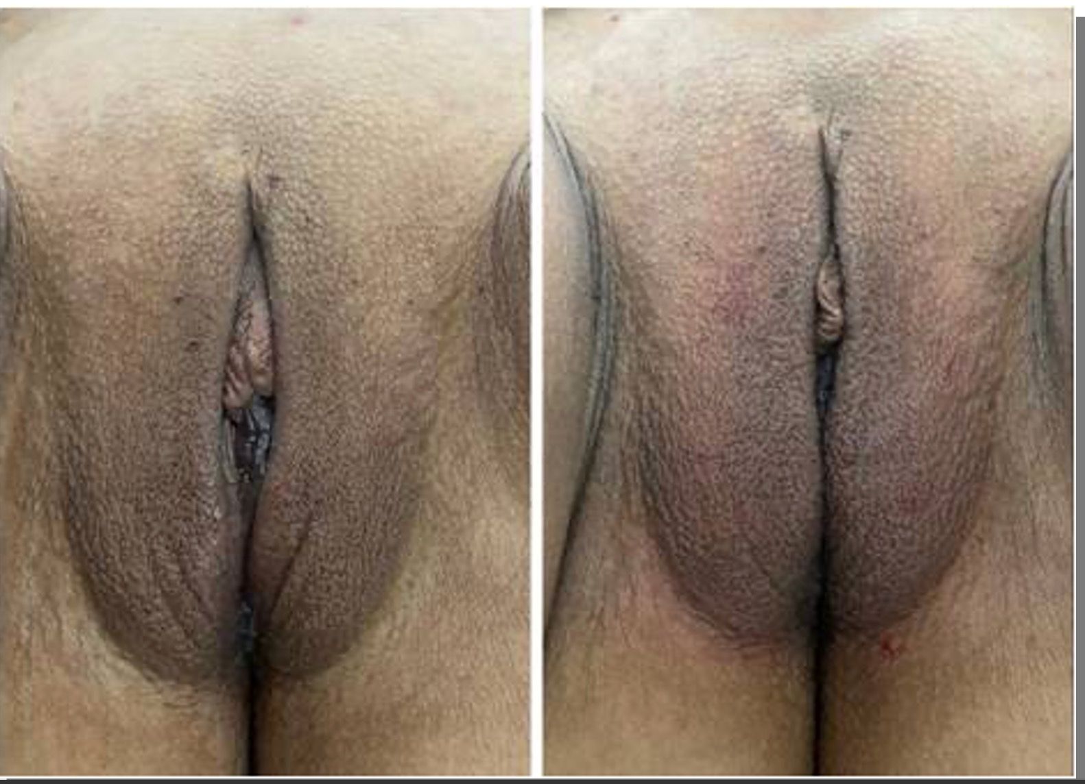 shortening major lips 1