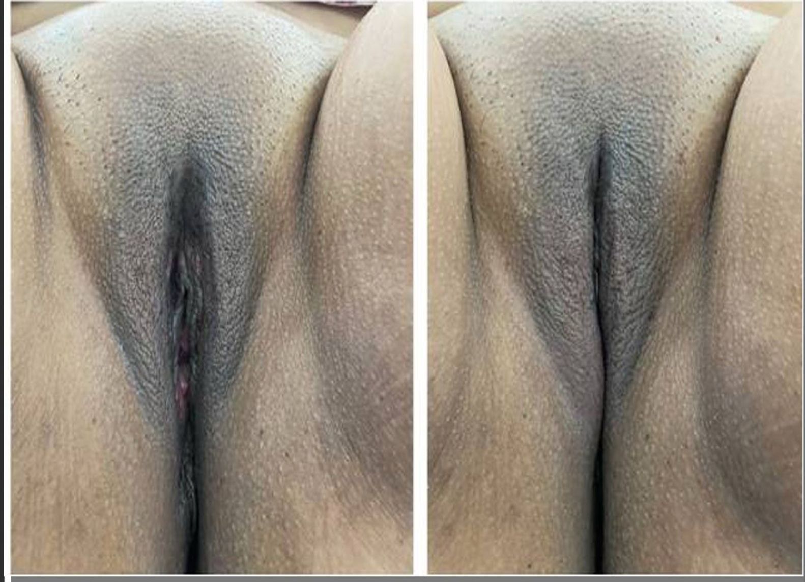 shortening-major-lips3