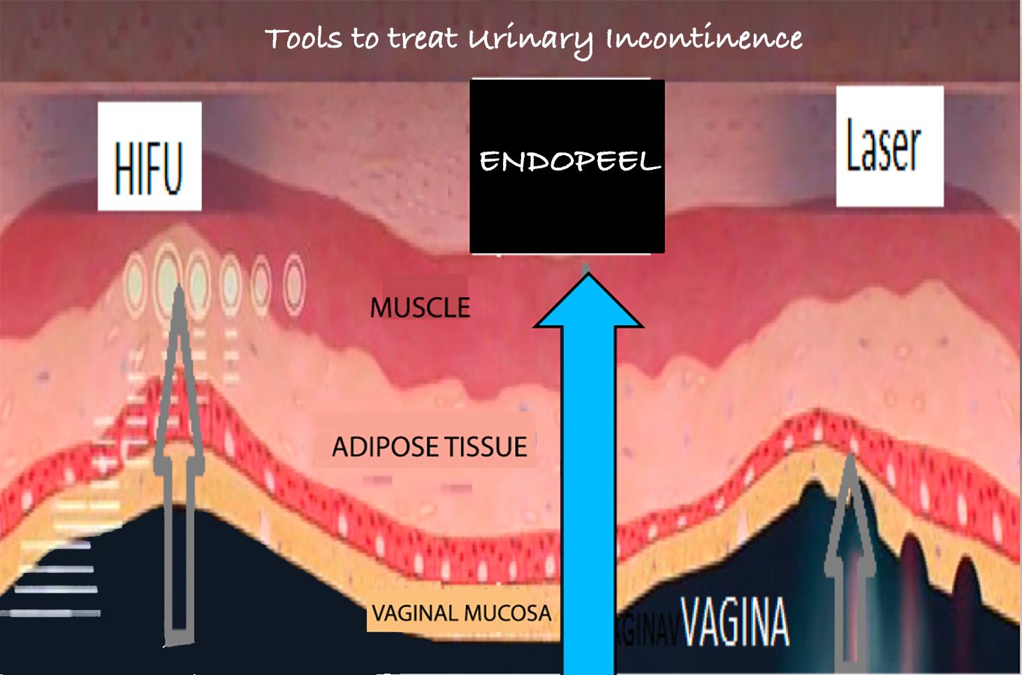 tools for urinary incontinence