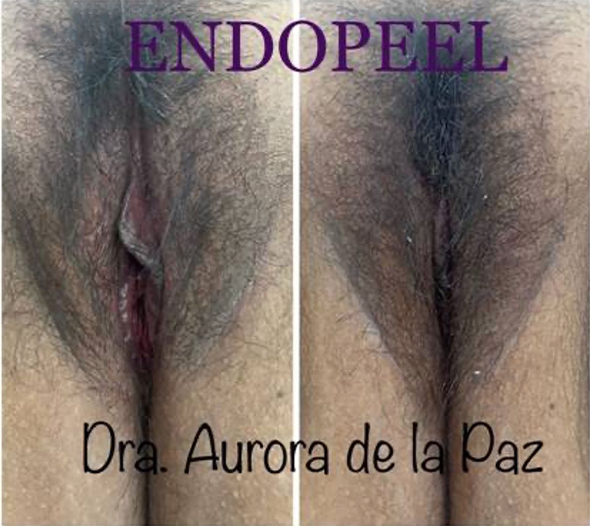 vaginal-vulvar-fork-tensioning3