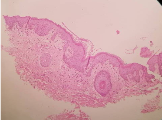 30 days biopsy post endopeel +PRP on large labia