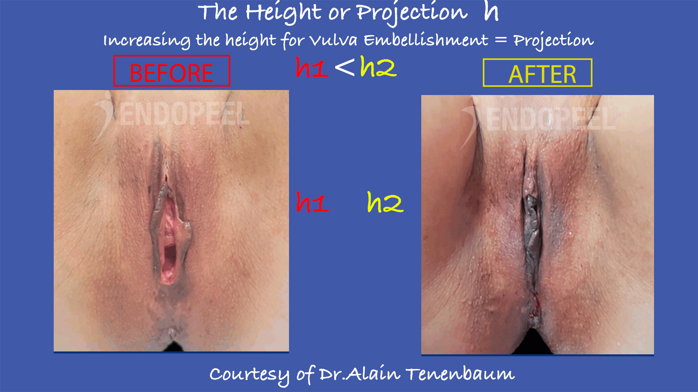 compare-height-vulva-embellishment.jpg