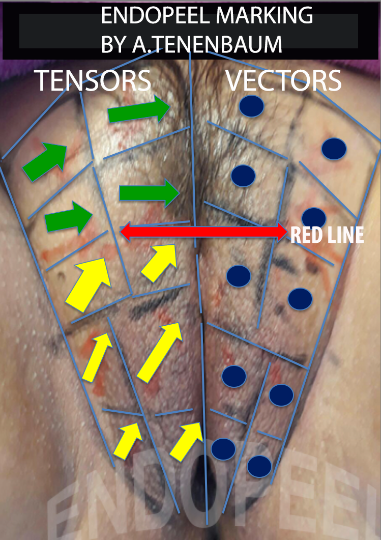 endopeel-marking-gyneco.png