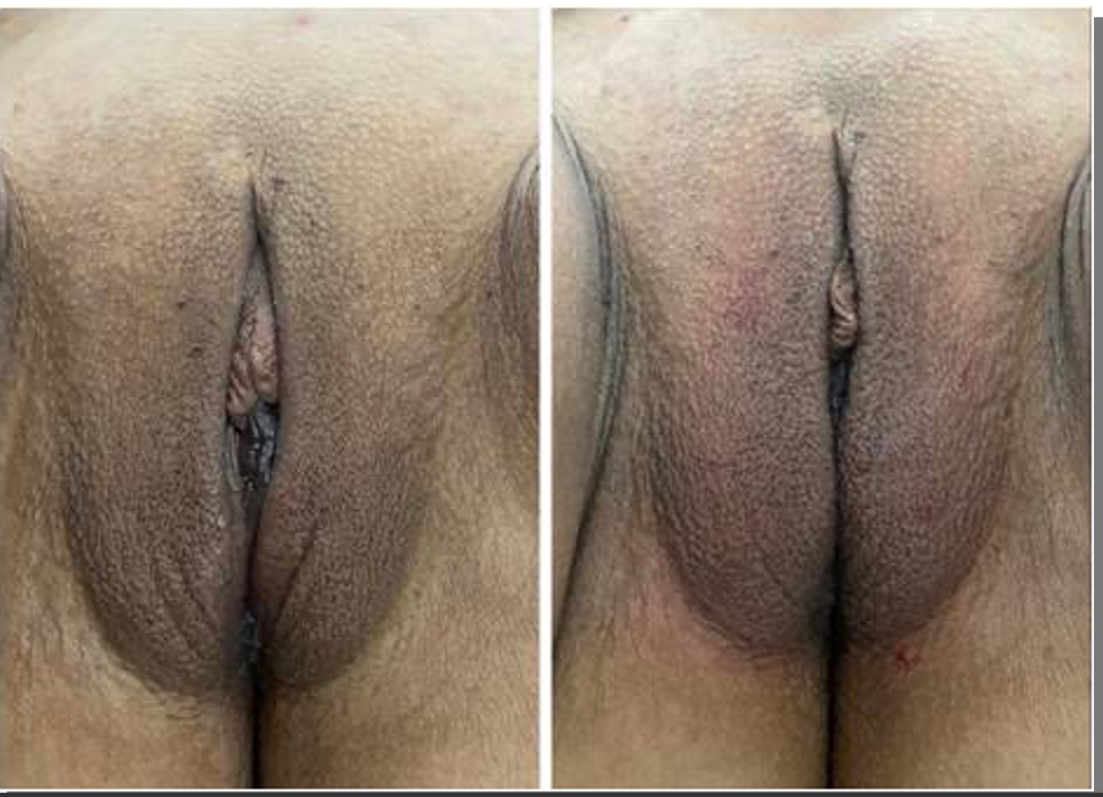 shortening major lips 1