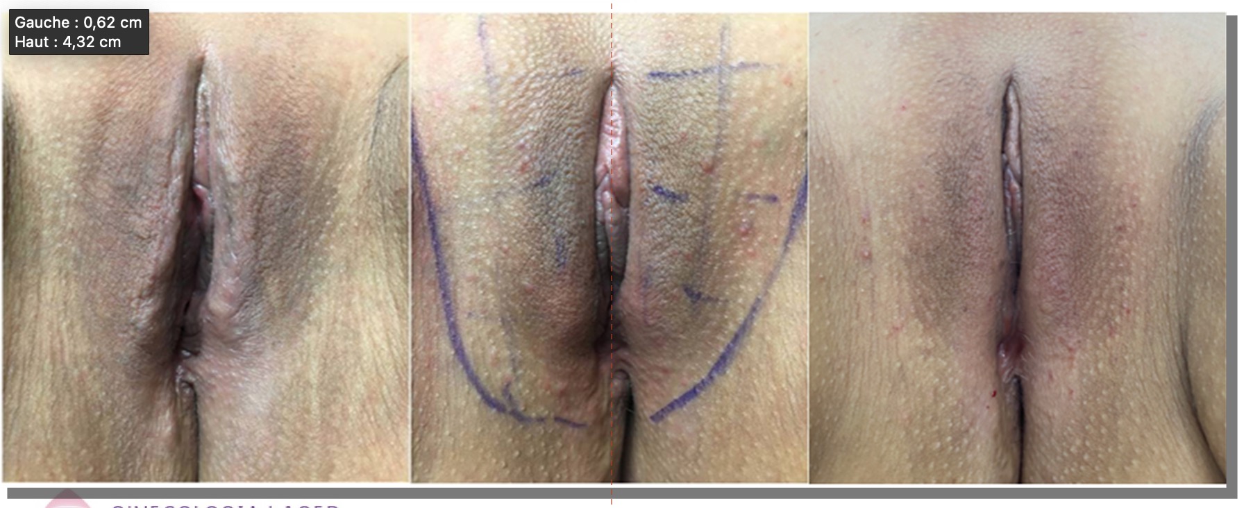 vulvar-tension-endopeel