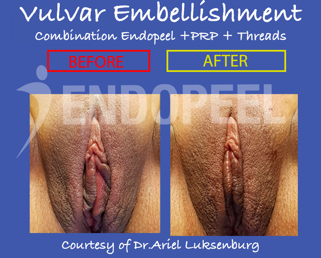vulvar-embellishment-combination-ariel.jpg