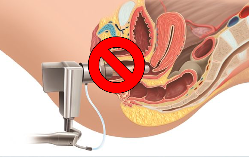 no laser vaginal