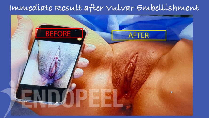 -result-endopeel-vulvar-embellishment