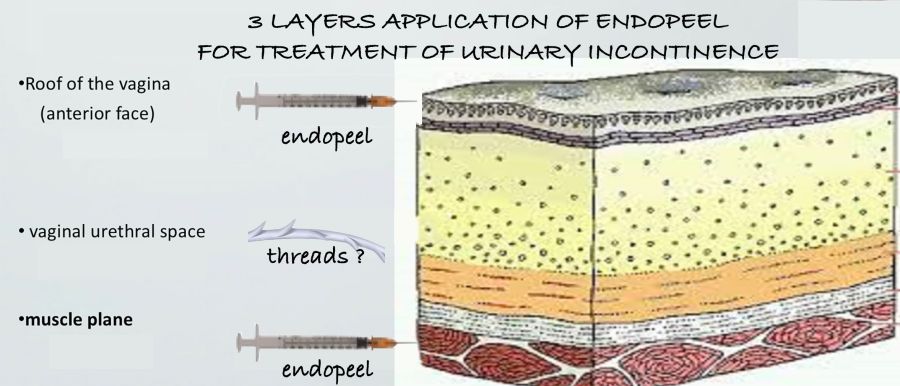 3D Application for urinary Incontinence