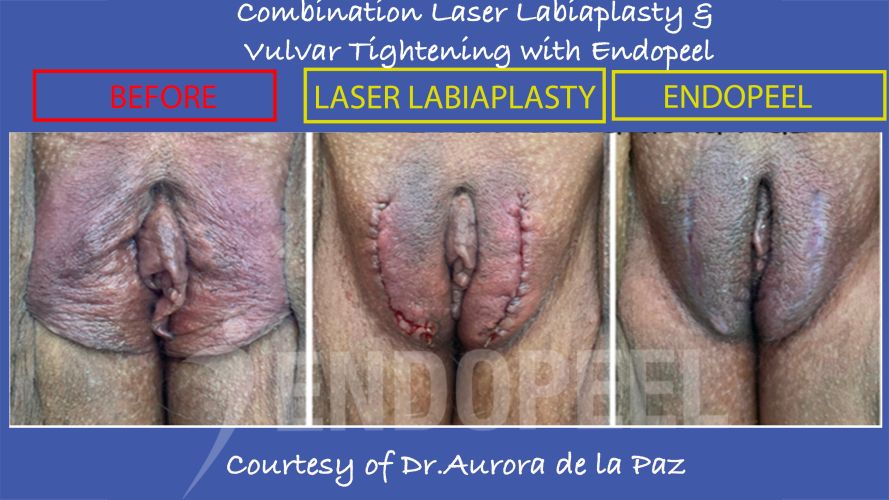 combination-laser-endopeel-gyn.jpg