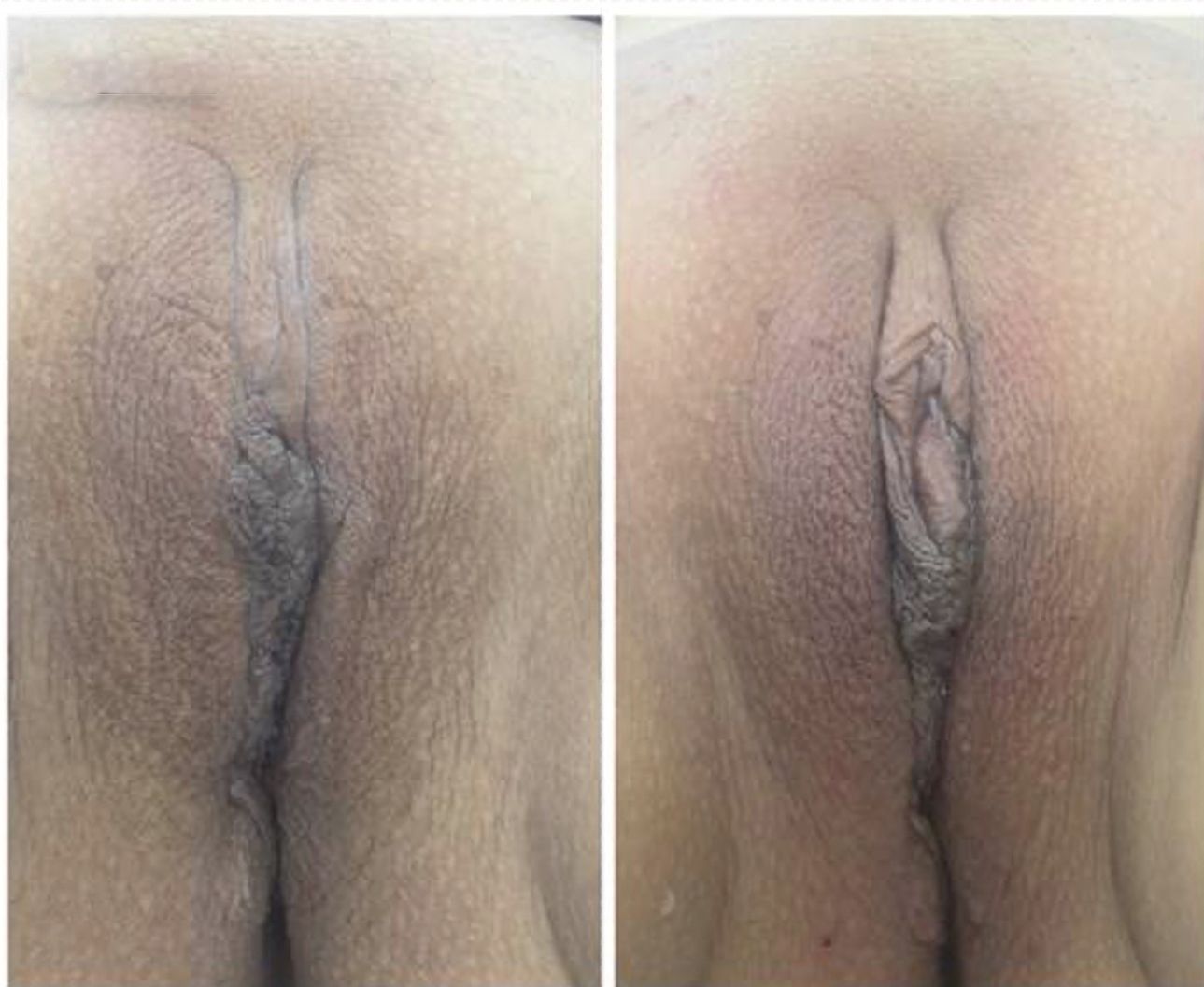 reposicionamineto-muscular1-endopeel