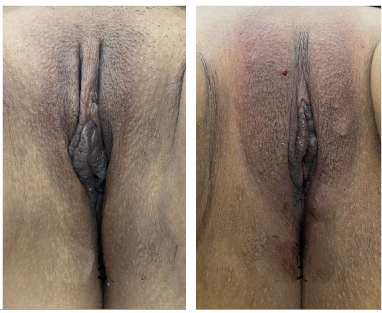 reposicionamineto-muscular3-endopeel