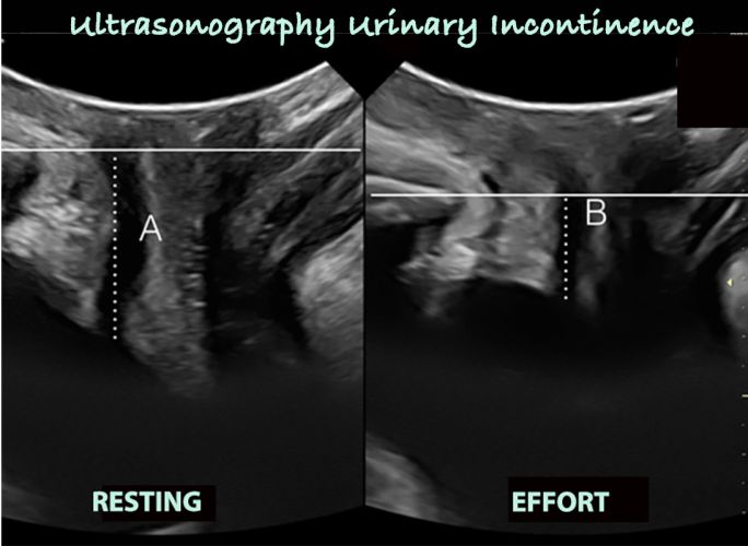 US-urinary-incontinence