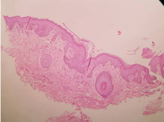 30 days biopsy post endopeel +PRP on large labia