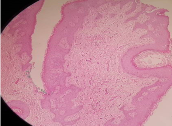 60 days biopsy post endopeel +PRP on large labia