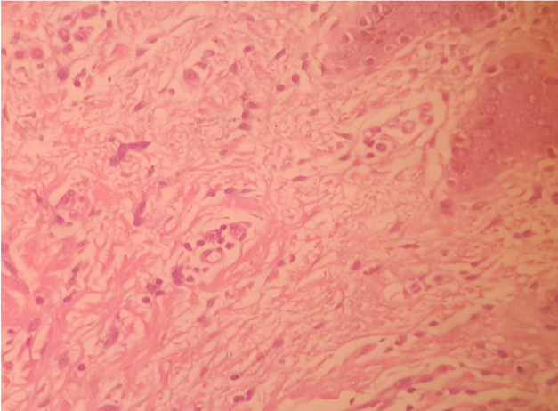 MACRO :60 days biopsy post endopeel +PRP on large labia