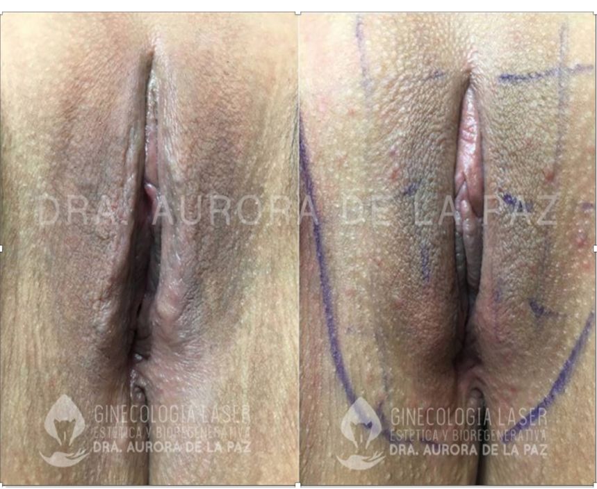 reposicionamineto-muscular2-endopeel