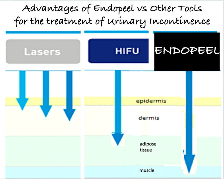 advantages-endopeel-vs-other-tools