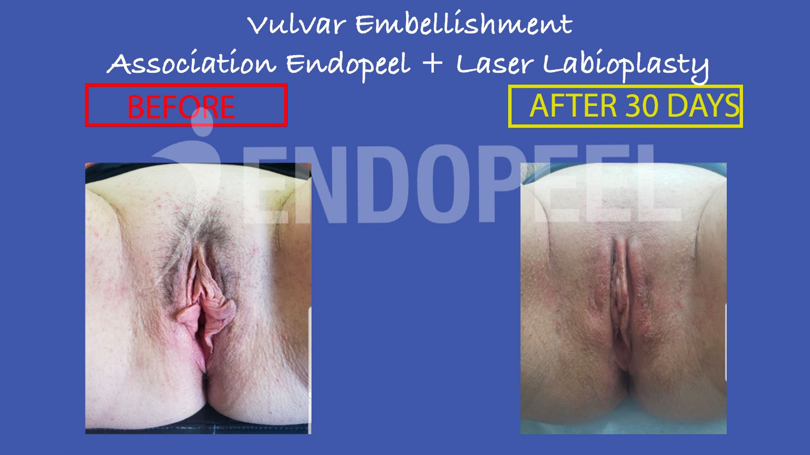 laserlabioplasty-endopeel2.jpg