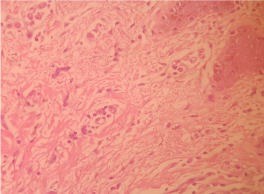 MACRO :60 days biopsy post endopeel +PRP on large labia