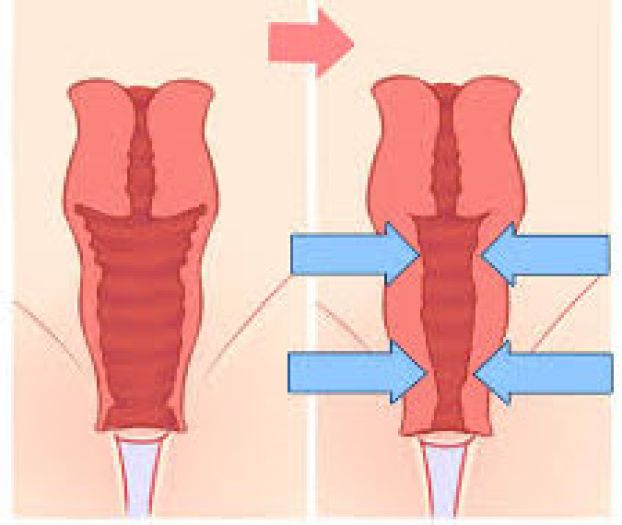 wall vaginal tightening