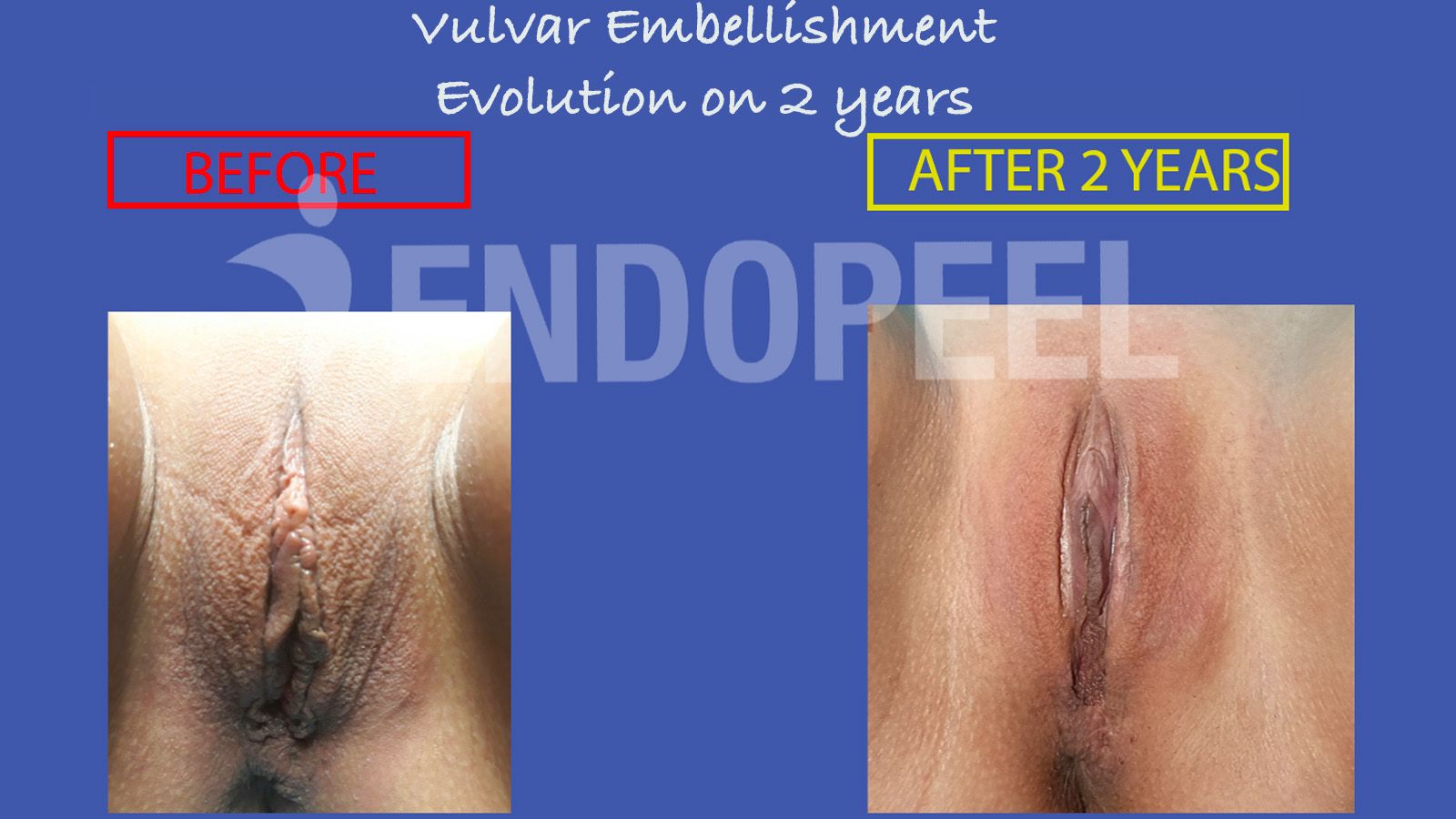 vulvar-embellishment-2y-2.jpg