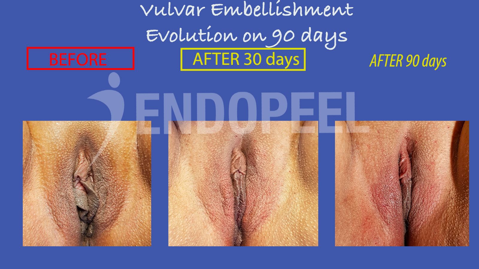 vulvar-embellishment90d-3.jpg