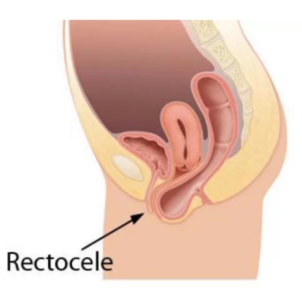 rectocele